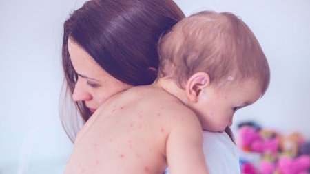 Baby with chicken pox needing a repairing care