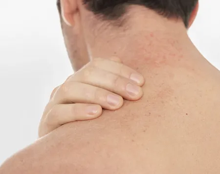 Atopic dermatitis on the back